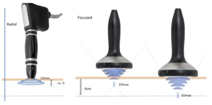 Image of Shockwave equipment showing the different depth of treatment using focused shockwave versus radial shockwave treatment